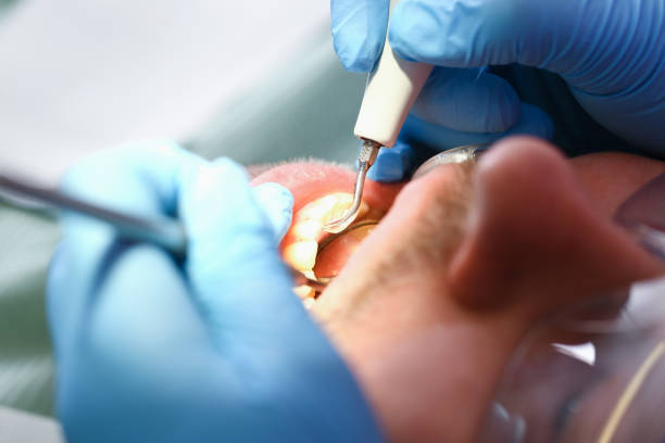Best Emergency Tooth Extraction in Jamestown, NY