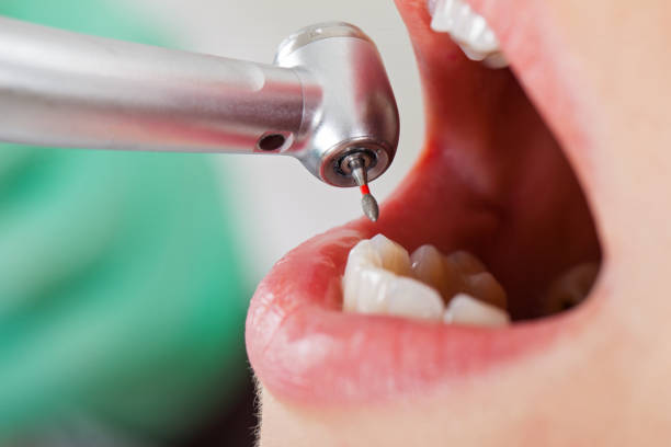 Best Emergency Tooth Extraction in Jamestown, NY
